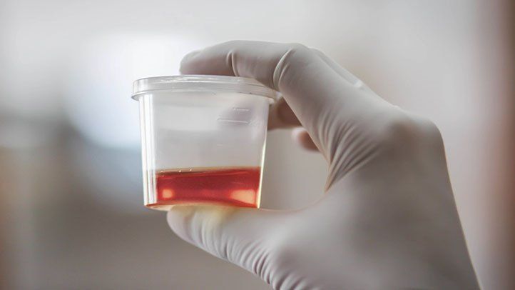 Hematuria Gross And Things You Should Know About