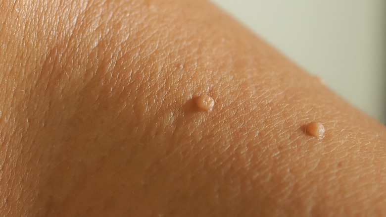 Skin Tag Removal: A Comprehensive Guide to Clearer Skin