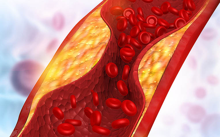 High Triglycerides and the Hidden Dangers to Your Health