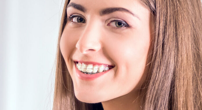 FAQs About Clear Braces