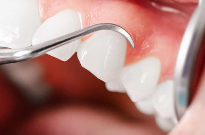 Gum Abscesses: Causes, Symptoms and Treatments