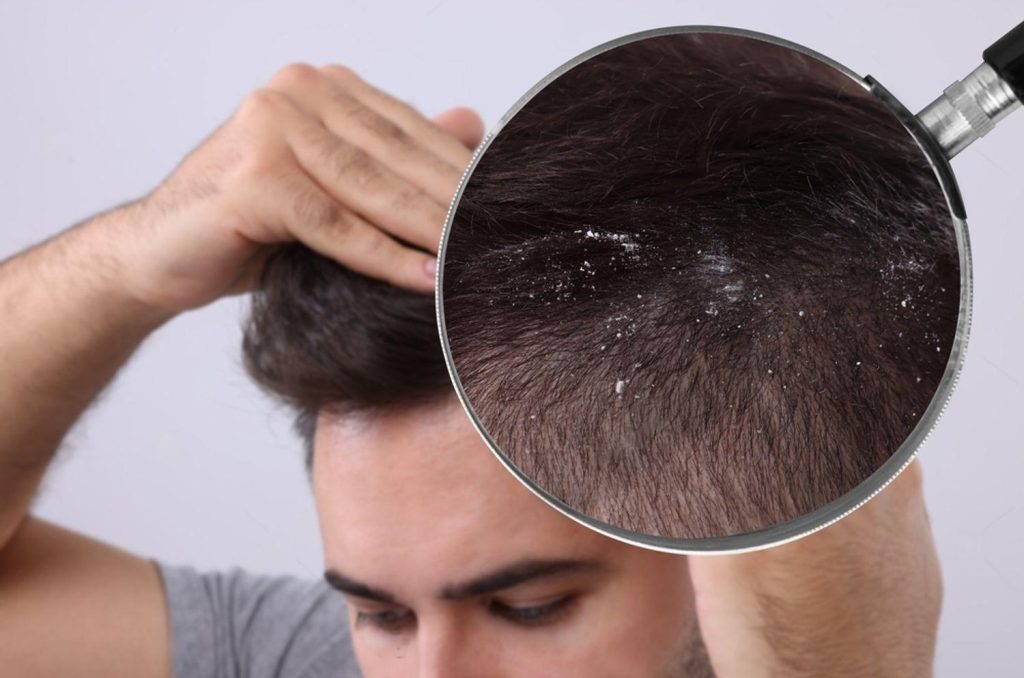 Do You Want Dandruff-Free Hair? Use These Effective Tips